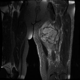 MFH Thigh Coronal MRI